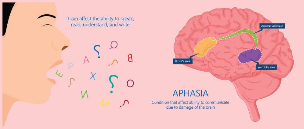 What Does it Mean to Have Expressive or Receptive Aphasia